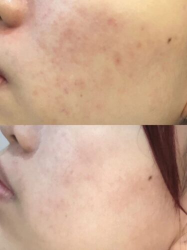 No More Acne Duo Cream (6g) photo review