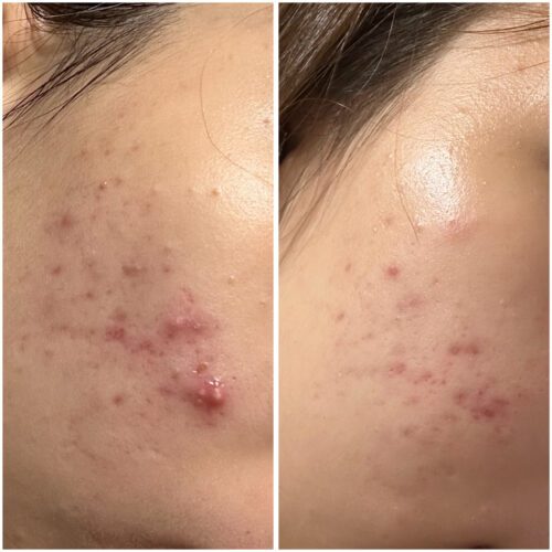 No More Acne Duo Cream (6g) photo review