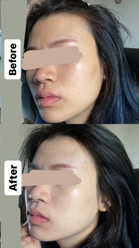 No More Acne Duo Cream (6g) photo review