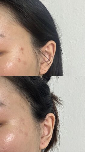 No More Acne Duo Cream (6g) photo review