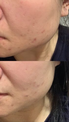 No More Acne Duo Cream (6g) photo review