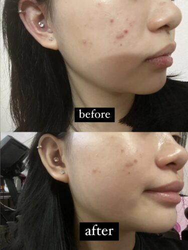 No More Acne Duo Cream (6g) photo review