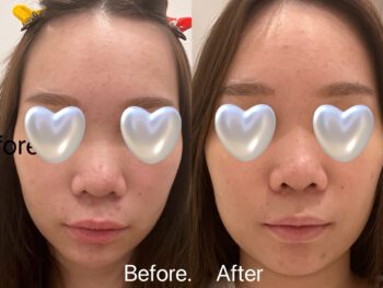 No More Acne Essence Toner (30ml/100ml) photo review
