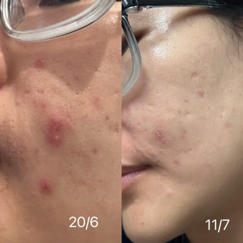 No More Acne Duo Cream (6g) photo review