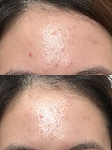 No More Acne Duo Cream (6g) photo review