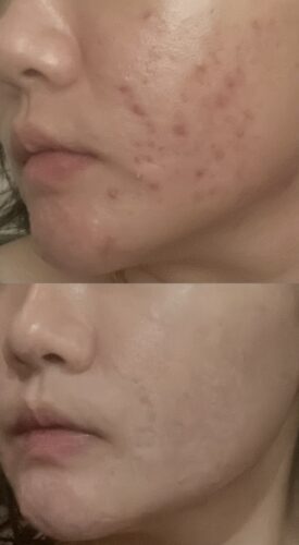 No More Acne Duo Cream (6g) photo review