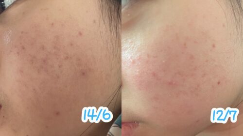 No More Acne Duo Cream (6g) photo review