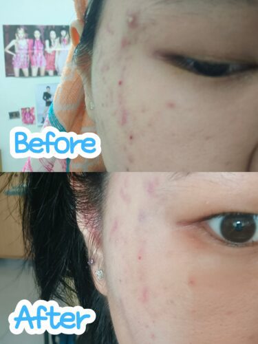 No More Acne Duo Cream (6g) photo review