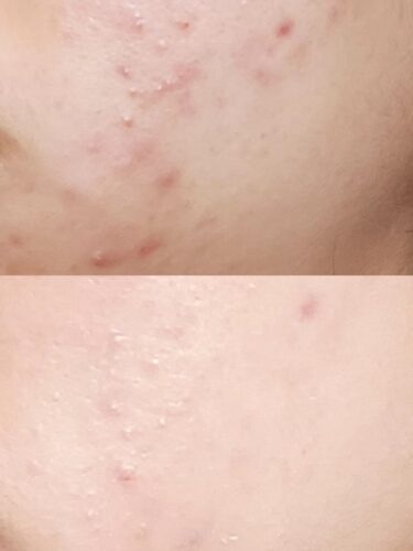 No More Acne Duo Cream (6g) photo review