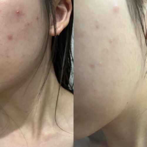 No More Acne Duo Cream (6g) photo review