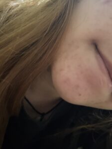 Click to view full screen No More Acne Duo Cream 2.0 (10g) photo review